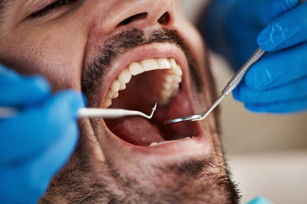 Best Emergency Treatment for Dental Infections or Abscesses in Chittenango, NY